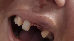 Após dizer que era bonita mulher tem dentes arrancados e cabelos cortados