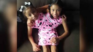 Gêmeas siamesas mostram superação e felicidade: conheça a história de Yara e Yasmin Santos